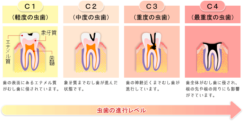 むし歯の進行レベル