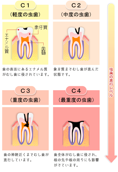 むし歯の進行レベル