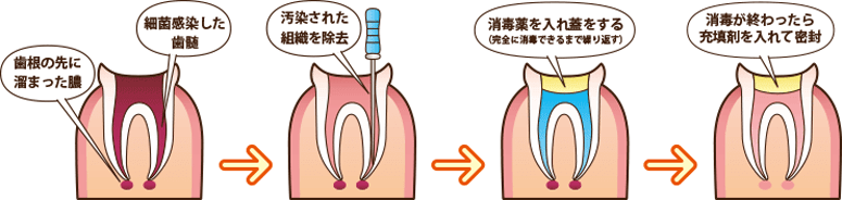 歯を抜かない治療