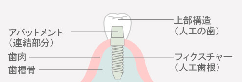 インプラントの構造