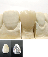 硬質レジン前装冠