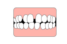 歯と歯の間に隙間がある